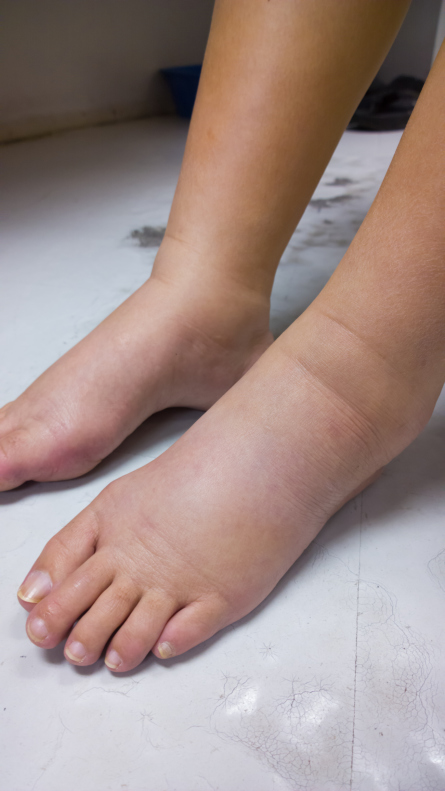 What Would Cause Swelling In Your Legs And Feet 89