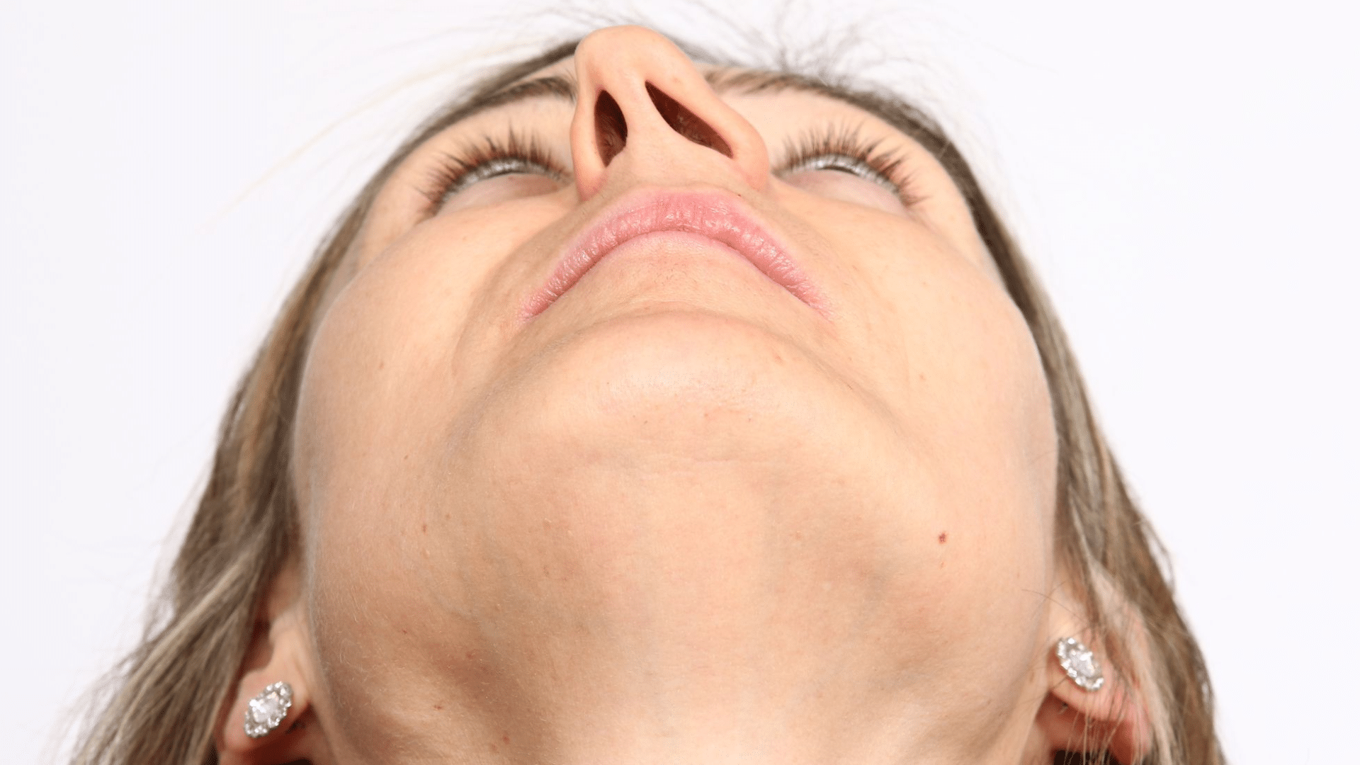 Can a Deviated Septum Cause Sleep Apnea?