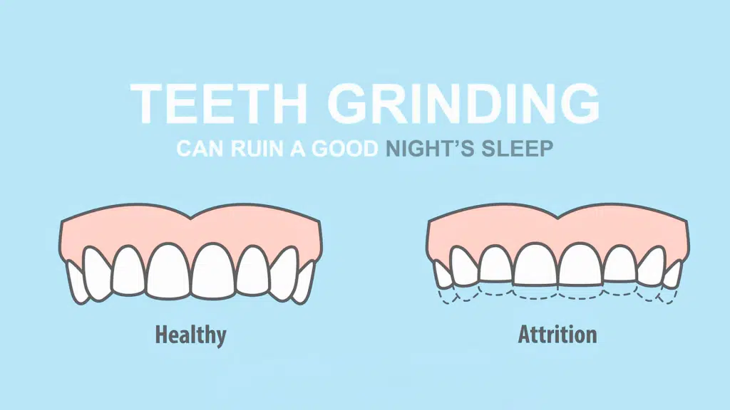grinding-teeth