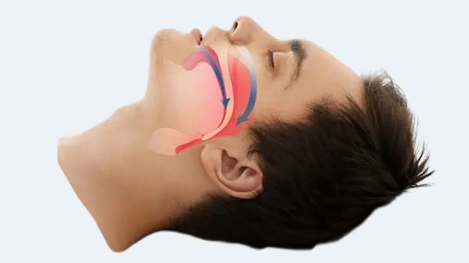 sleep-apnea-misread-as-choking