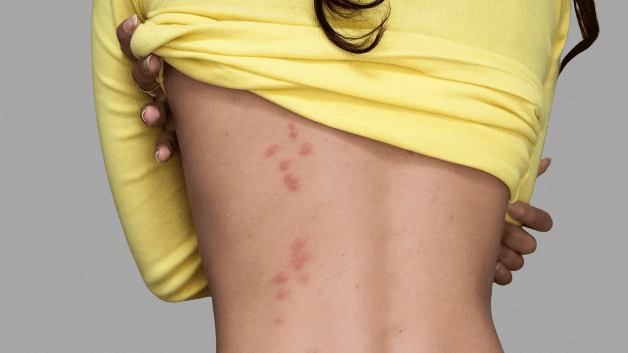 red, clustered bed bug bite marks visible along the side of a person’s torso.