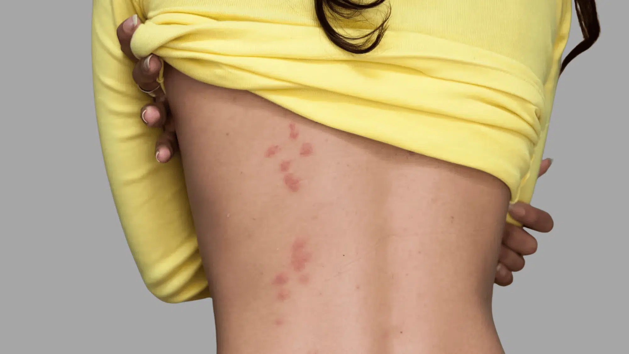 red, clustered bed bug bite marks visible along the side of a person’s torso.