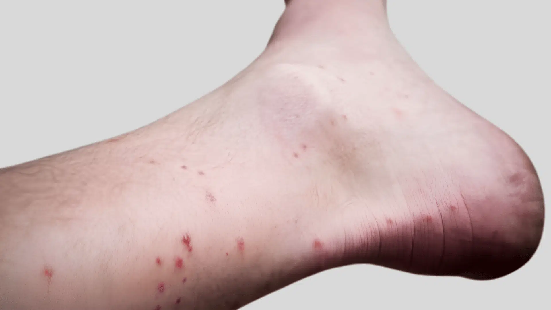 multiple small, red flea bite marks scattered around a person’s ankle and lower leg.