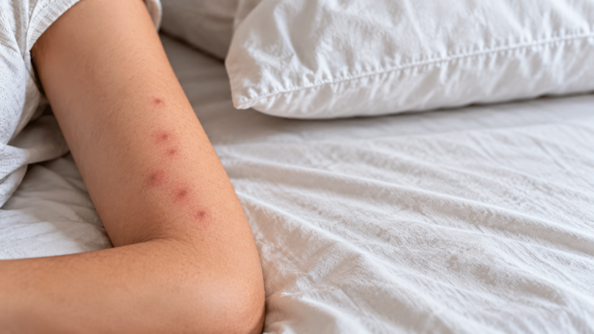 small red itchy bumps clustered on a person's arm while resting on clean white bedding